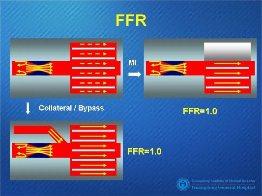 ffr智能算法 让你了解ffr智能算法的优势和应用